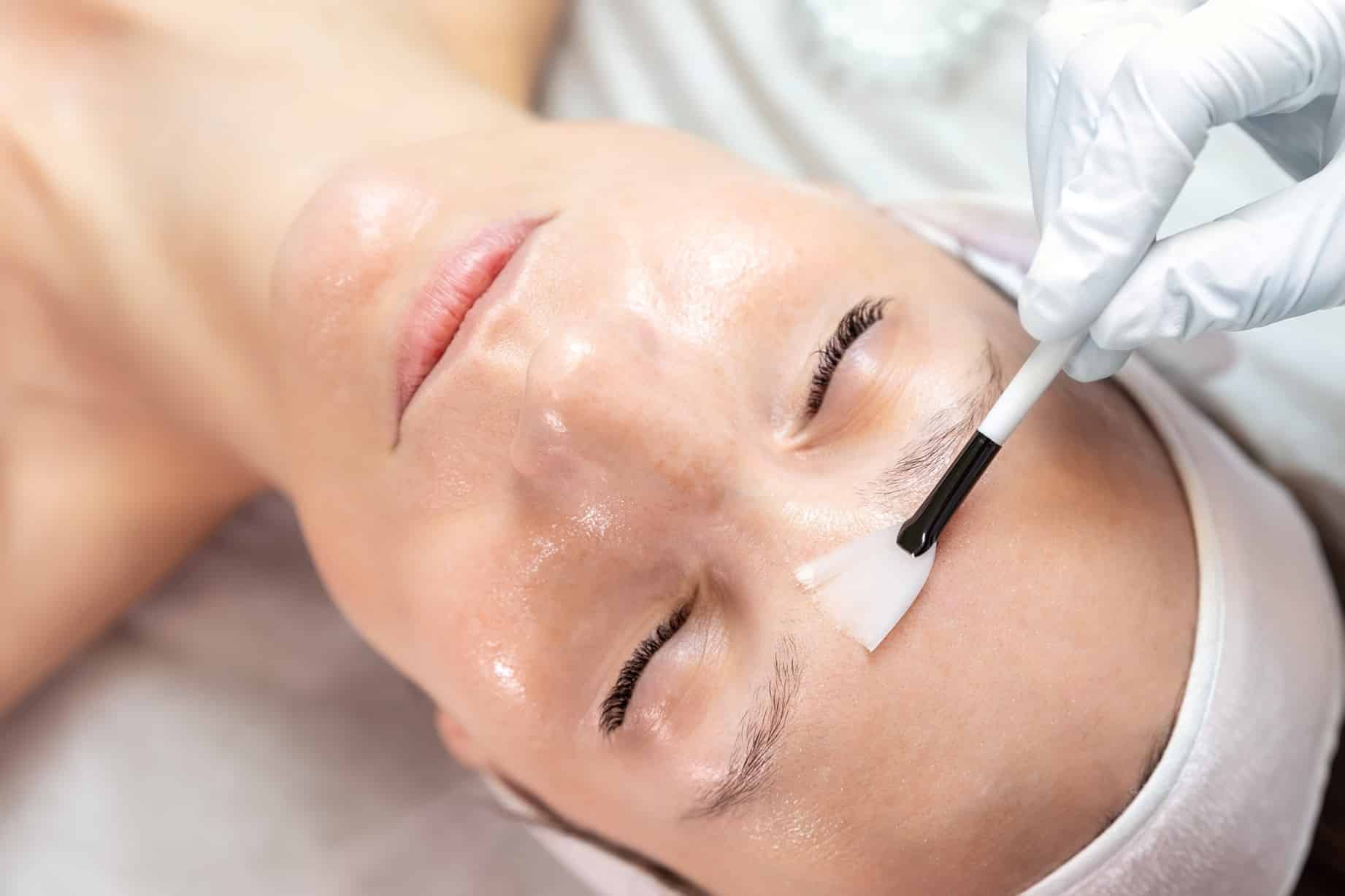 Close up of a woman’s face as she lies on her back with her eyes closed and a gloved hand brushes a chemical peel product onto her skin.