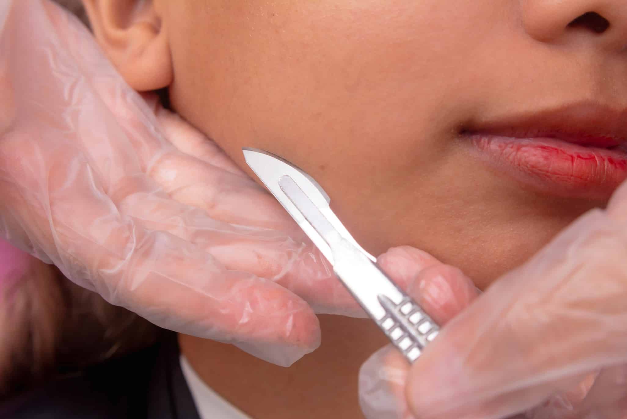 Close up of a woman’s cheek and the side of her mouth as two gloved hands hold a dermaplaning blade next to her cheek.