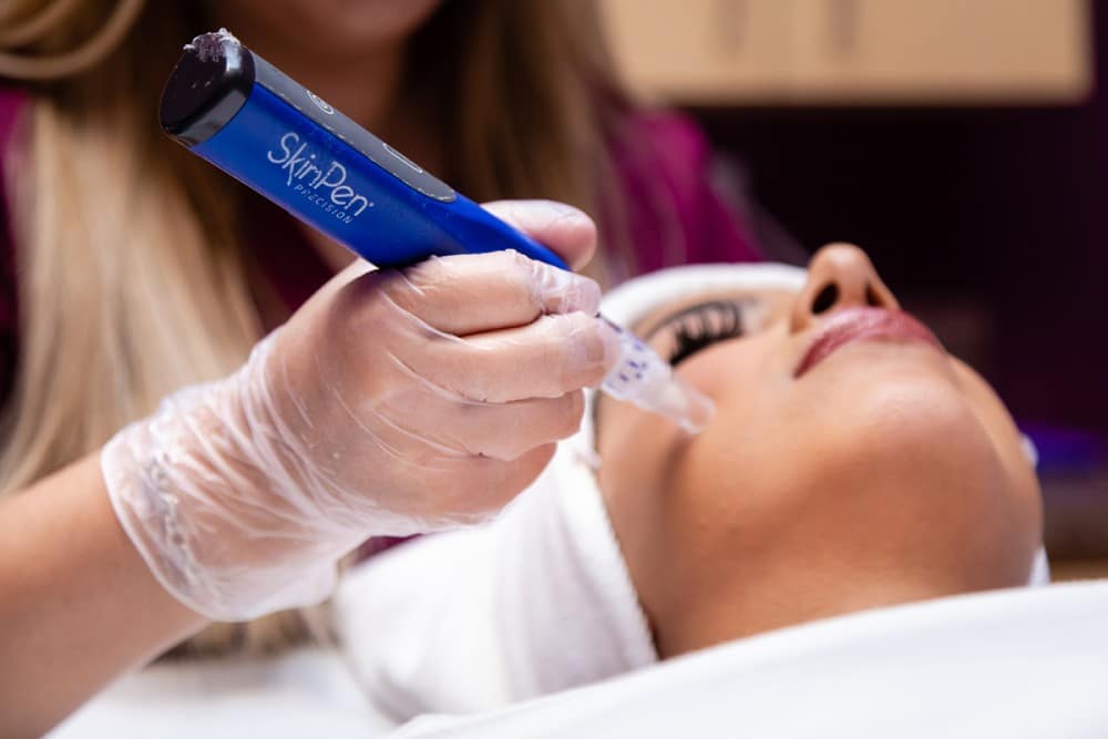 A skincare professional in clear gloves uses a blue microneedling pen tool on a client's face during a skin treatment.